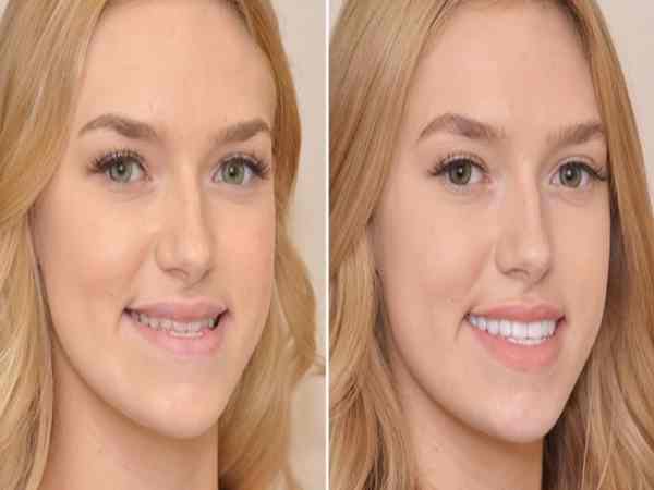 Miệng móm là gì? Miệng móm là gì?